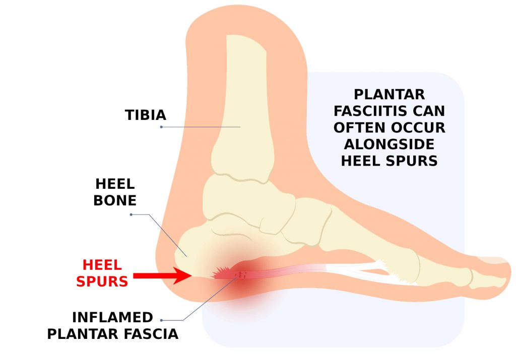 Heel spurs can be caused by long term pain and non-treatment of Plantar Fasciitis
